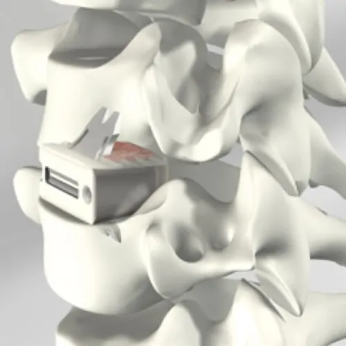 arthrodese cervicale complication arthrodese cervicale avec pose de cage chirurgie du rachis espace francilien du rachis clinique du rachis versailles paris 1