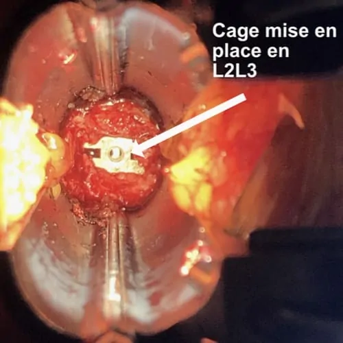 arthrodese lombaire laterale arthrodese lombaire par voie laterale chirurgie du rachis espace francilien du rachis clinique du rachis versailles paris 7