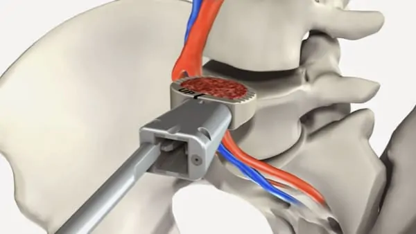 arthrodese lombaire par voie anterieure arthrodese lombaire voie anterieure pourcentage de reussite chirurgie du rachis espace francilien du rachis clinique du rachis versailles paris 2