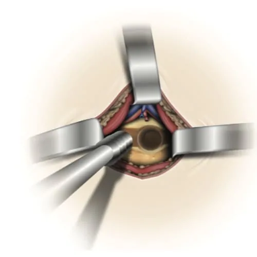 arthrodese lombaire par voie anterieure arthrodese lombaire voie anterieure pourcentage de reussite chirurgie du rachis espace francilien du rachis clinique du rachis versailles paris 5
