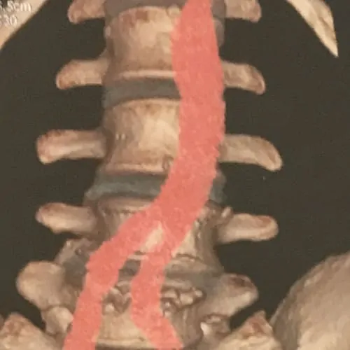arthrodese lombaire par voie anterieure arthrodese lombaire voie anterieure pourcentage de reussite chirurgie du rachis espace francilien du rachis clinique du rachis versailles paris 9