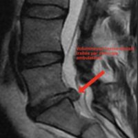 chirurgie d une hernie discale lombaire symptomes hernie discale lombaire operation chirurgie du rachis espace francilien du rachis clinique du rachis versailles paris 5