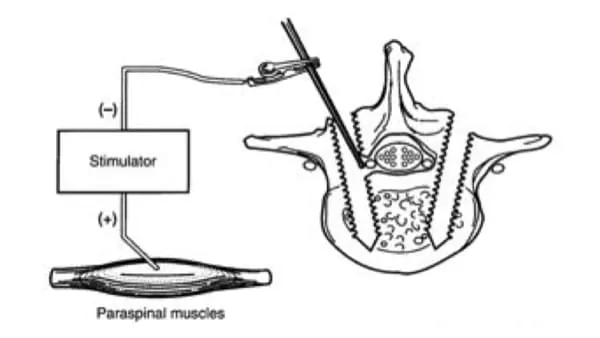 chirurgie du rachis neurostimulation medullaire probleme de dos espace francilien du rachis clinique du rachis versailles paris 3