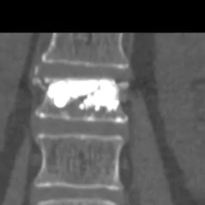 Scanner après cimentoplastie : le ciment apparaît en blanc à l’intérieur de la vertèbre