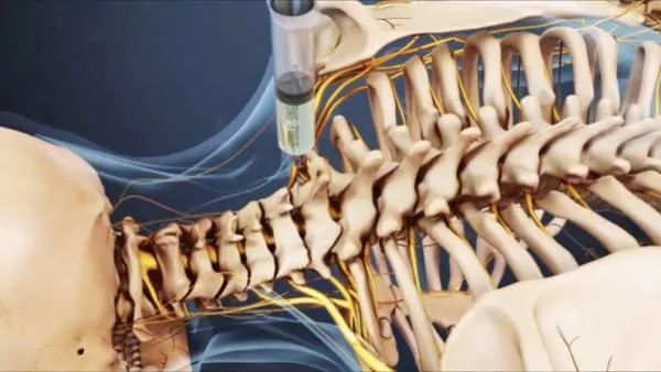 infiltration nevralgie cervico brachiale traitement nevralgie cervico brachial nevralgie cervico brachiale cause espace francilien du rachis clinique du rachis versailles paris