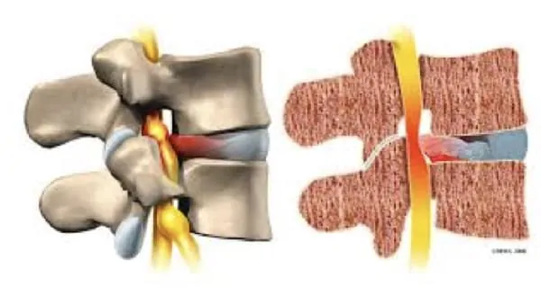 laminectomie lombaire laminectomie definition laminectomie cervicale reeducation chirurgie du rachis espace francilien du rachis clinique du rachis versailles paris 1