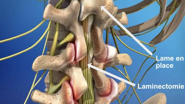 laminectomie lombaire laminectomie definition laminectomie cervicale reeducation chirurgie du rachis espace francilien du rachis clinique du rachis versailles paris 3