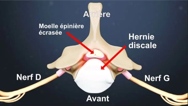 myelopathie cervico arthrosique myelopathie cervicarthrosique et fatigue myelopathie cervicarthrosique irm espace francilien du rachis clinique du rachis versailles paris 4