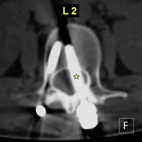 navigation 3d rachidienne operation du rachis lombaire operation du rachis cervical c6 c7 espace francilien du rachis clinique du rachis versailles paris 9