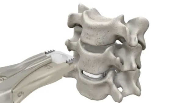prothese discale cervicale remboursement prothese discale avis chirurgie du rachis espace francilien du rachis clinique du rachis versailles paris 6