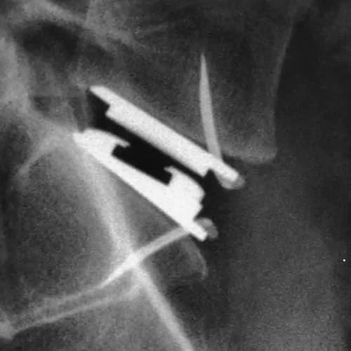 prothese discale lombaire prix chirurgie prothese discale lombaire reeducation chirurgie du rachis espace francilien du rachis clinique du rachis versailles paris 3