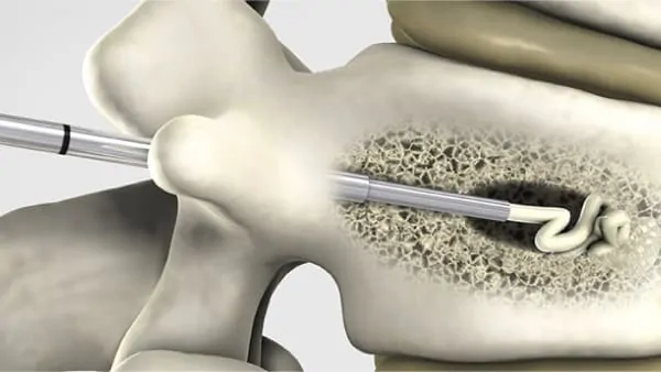 reeducation apres cimentoplastie cancer cimentoplastie lombaire chirurgie du rachis espace francilien du rachis clinique du rachis versailles paris