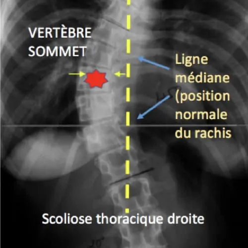 scoliose ado probleme de dos la scoliose lombaire scoliose definition scoliose traitement espace francilien du rachis clinique du rachis versailles paris 2