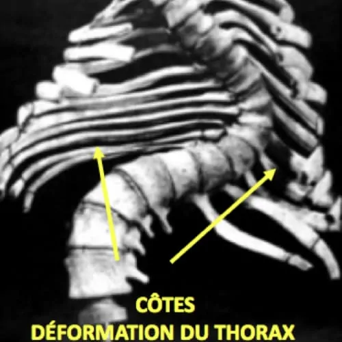 scoliose ado probleme de dos la scoliose lombaire scoliose definition scoliose traitement espace francilien du rachis clinique du rachis versailles paris 5