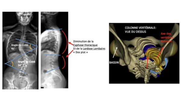 scoliose ado probleme de dos la scoliose lombaire scoliose definition scoliose traitement espace francilien du rachis clinique du rachis versailles paris