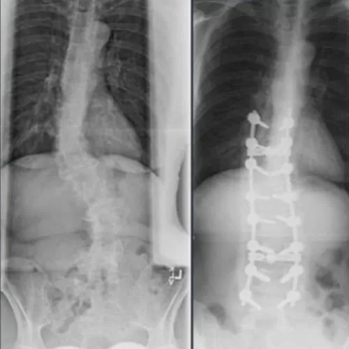 scoliose lombaire la scoliose adulte operation scoliose adulte traitement scoliose adulte que faire espace francilien du rachis clinique du rachis versailles paris 11