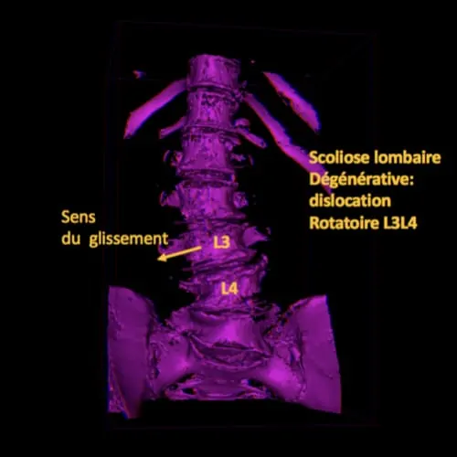 scoliose lombaire la scoliose adulte operation scoliose adulte traitement scoliose adulte que faire espace francilien du rachis clinique du rachis versailles paris 5 scoliose lombaire la scoliose adulte operation scoliose adulte traitement scoliose adulte que faire espace francilien du rachis clinique du rachis versailles paris 5
