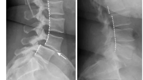 Spondylolisthésis : symptômes