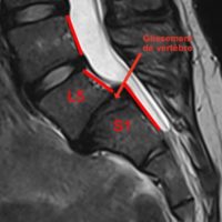 spondylolisthesis par lyse isthmique bilaterale spondylolisthesis traitement espace francilien du rachis clinique du rachis versailles paris 3