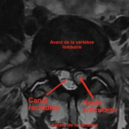 stenose lombaire severe stenose lombaire exercices stenose definition mal de dos lombaire espace francilien du rachis clinique du rachis versailles paris 4