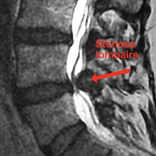 stenose lombaire severe stenose lombaire exercices stenose definition mal de dos lombaire espace francilien du rachis clinique du rachis versailles paris 5 stenose lombaire severe stenose lombaire exercices stenose definition mal de dos lombaire espace francilien du rachis clinique du rachis versailles paris 5