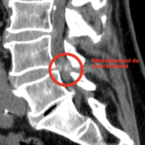 stenose lombaire severe stenose lombaire exercices stenose definition mal de dos lombaire espace francilien du rachis clinique du rachis versailles paris 6