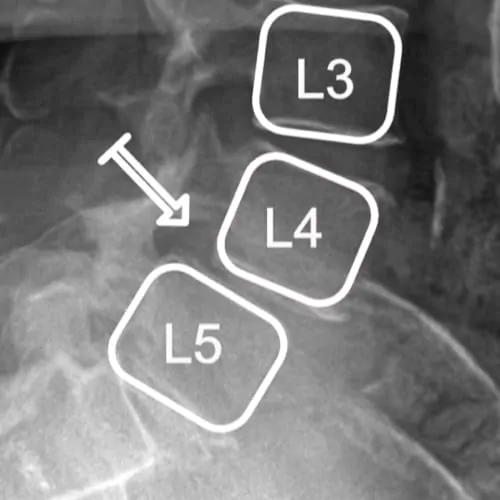 stenose lombaire severe stenose lombaire exercices stenose definition mal de dos lombaire espace francilien du rachis clinique du rachis versailles paris 7