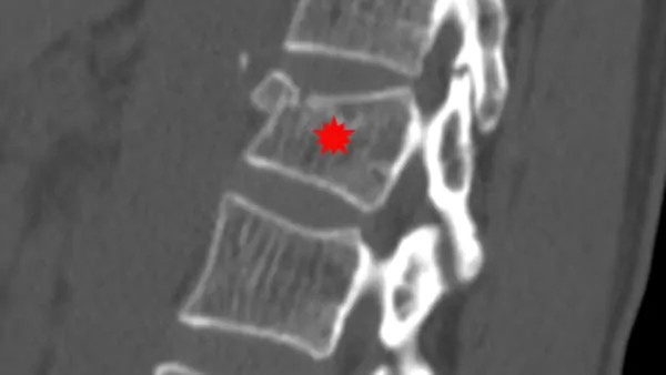 tassement vertebral traitement kine tassement de vertebre traitement tassement vertebral symptomes espace francilien du rachis clinique du rachis versailles paris 4 tassement vertebral traitement kine tassement de vertebre traitement tassement vertebral symptomes espace francilien du rachis clinique du rachis versailles paris 4