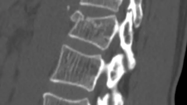 tassement vertebral traitement kine tassement de vertebre traitement tassement vertebral symptomes espace francilien du rachis clinique du rachis versailles paris