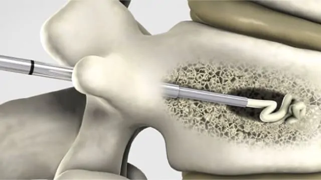 Radiographie après cimentoplastie : ciment injecté dans la vertèbre fracturée