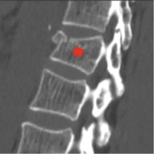 Radiographie de profil : tassement d’une vertèbre sur un os ostéoporotique après une chute sur les fesses