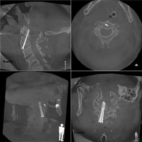 imagerie 3d ziehm traitement fracture du rachis cervical espace francilien rachis docteur jameson docteur lamerain