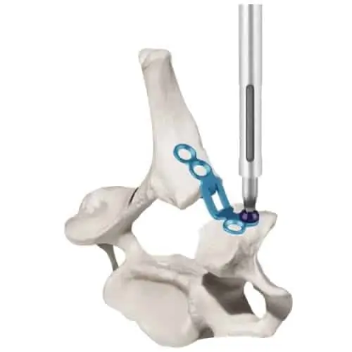 lame canal rachidien laminoplastie espace francilien rachis chirurgien specialiste dos paris dr jameson dr lamerain