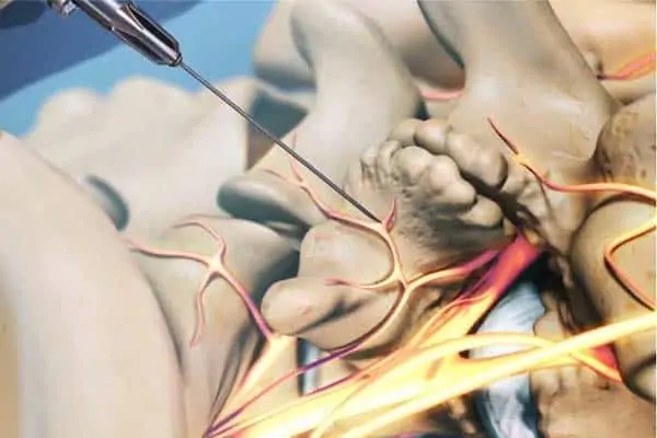 neurolyse facettaire sacro iliaque espace francilien rachis chirurgien specialiste dos colonne vertebrale paris dr jameson dr lamerain medecin de la douleur dr hayon dr labourdette paris