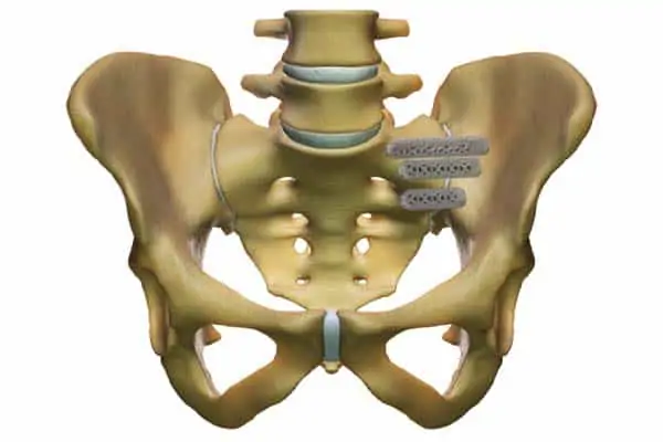 operation sacro iliaque espace francilien rachis chirurgien specialiste dos colonne vertebrale paris dr jameson dr lamerain medecin de la douleur dr hayon dr labourdette paris