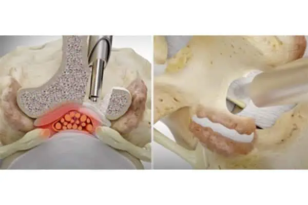 arthrose lombaire operation chirurgie du rachis espace francilien du rachis clinique du rachis versailles paris