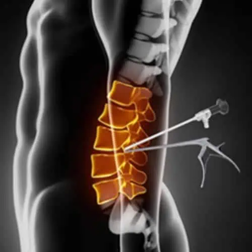 chirurgie endoscopique rachis lombaire espace francilien du rachis clinique du rachis versailles paris