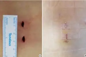 Deux incisions d’environ un centimètre dans le bas du dos, mesurées à la règle, puis les mêmes cicatrices une fois refermées