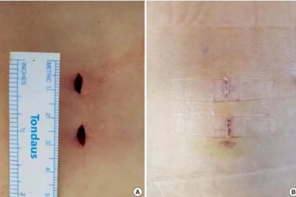 cicatrice de chirurgie endoscopique du dos chirurgie du rachis espace francilien du rachis clinique du rachis versailles paris