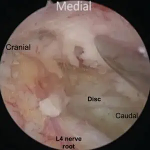 Vue du chirurgien à travers l’endoscope : la racine nerveuse L4 dégagée et le disque intervertébral