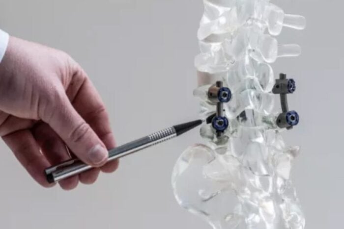 arthrodese lombaire perte mobilite chirurgie du rachis espace francilien du rachis clinique du rachis versailles paris