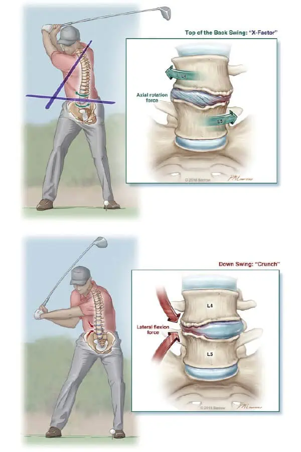 Contraintes du swing de golf sur la colonne lombaire (illustration)