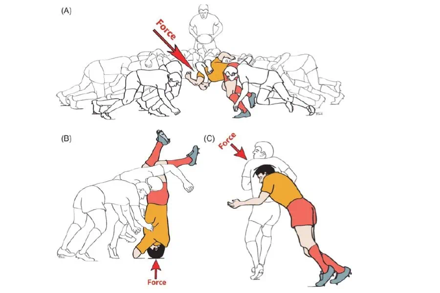 Mécanismes des blessures du cou au rugby : flexion forcée au plaquage et compression en mêlée (illustration)