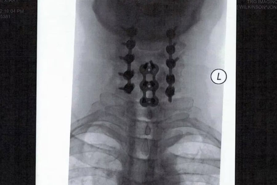 radiographies jonny wilkinson rachis cervical chirurgie du rachis espace francilien du rachis clinique du rachis versailles paris