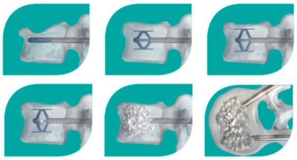 Les étapes d’une cyphoplastie : introduction de l’implant dans la vertèbre tassée, déploiement progressif pour lui redonner de la hauteur, puis injection de ciment