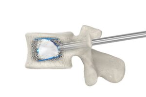 Vertèbre vue de profil, en coupe : implant de cyphoplastie déployé dans le corps vertébral et fixé par le ciment, avec la canule d’injection introduite par l’arrière de la vertèbre
