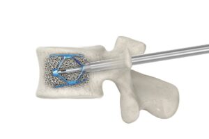 Implant expansible de cyphoplastie déployé à l’intérieur d’une vertèbre, avec son instrument d’introduction