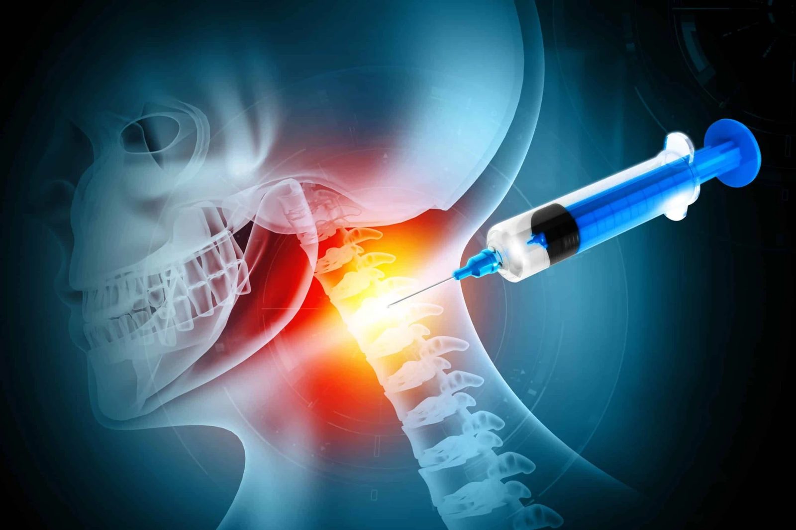Infiltration cervicale réalisée sous contrôle radiologique (illustration)