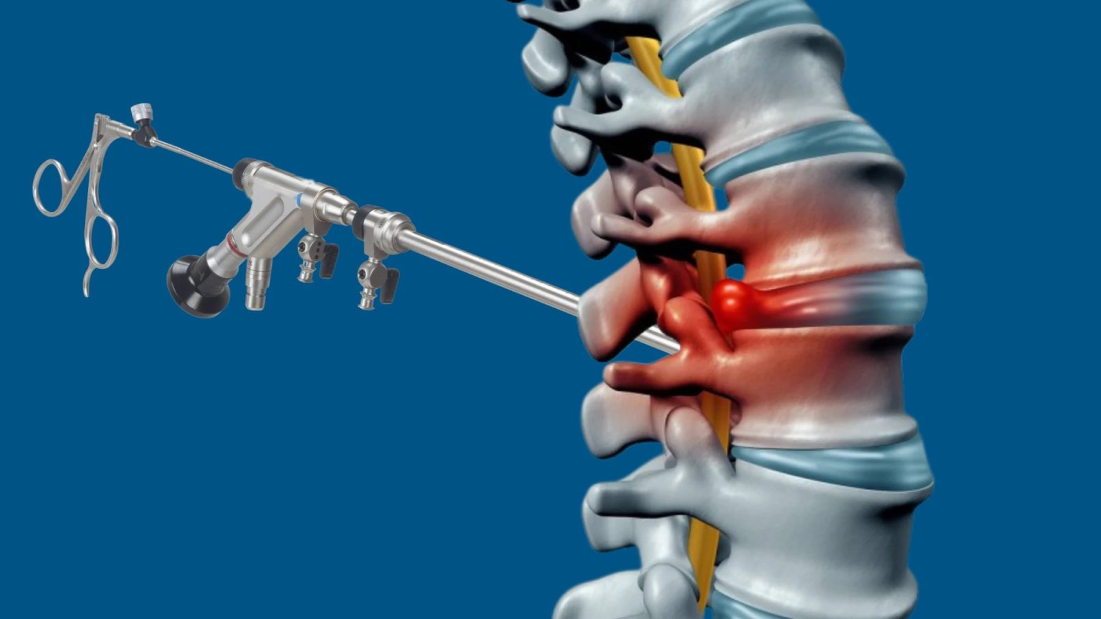 Opération d’une hernie discale lombaire par endoscopie (illustration)