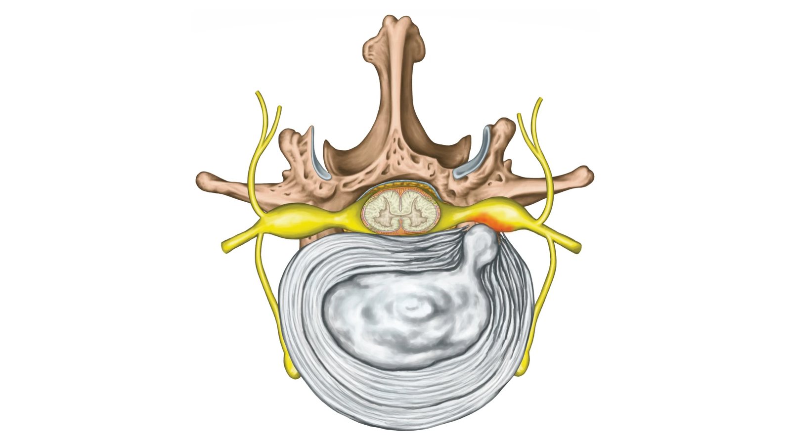 Disque intervertébral vu de dessus, avec une hernie discale qui déborde vers une racine nerveuse (illustration)